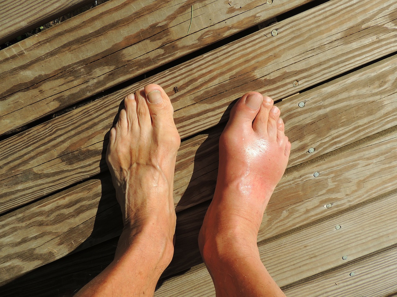 Image - feet gout pain foot human anomaly