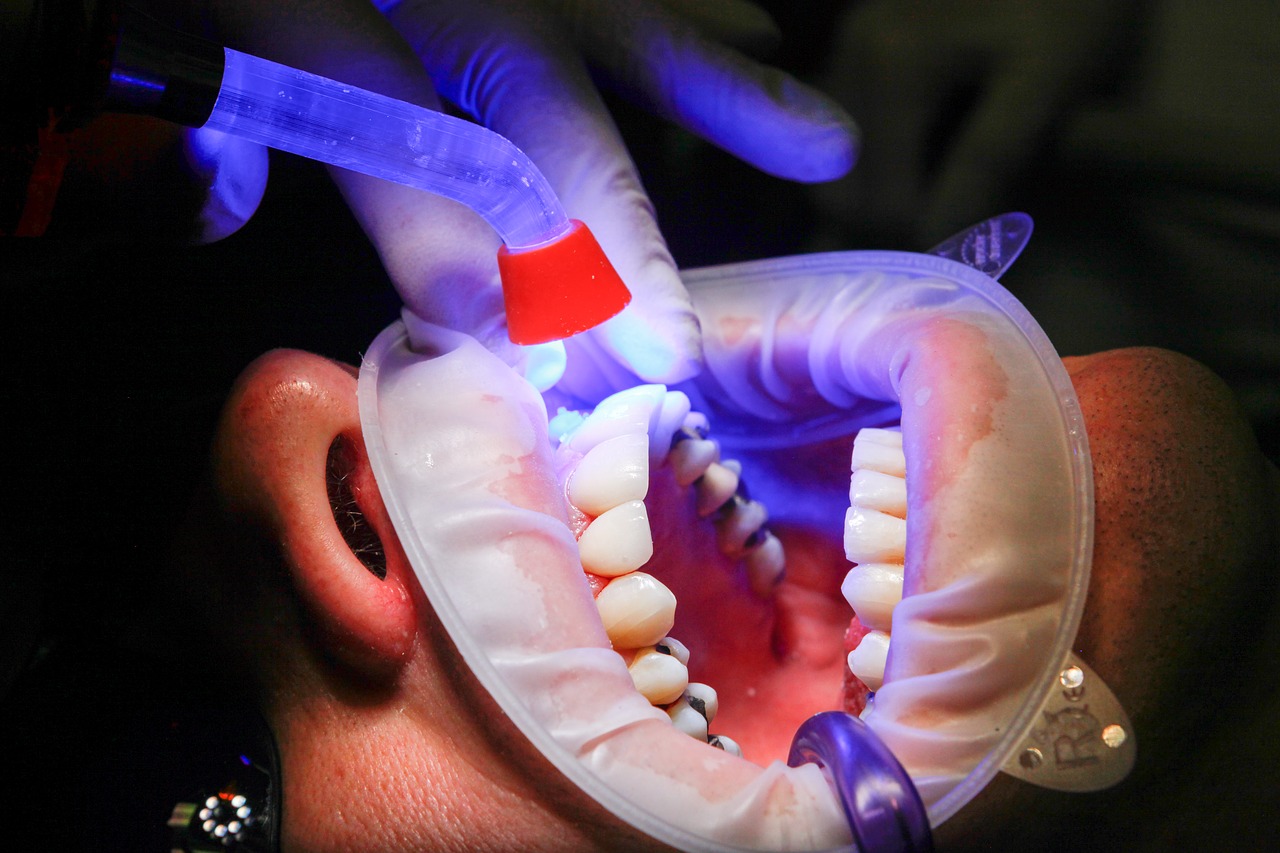 Image - dentist facet uv light curing