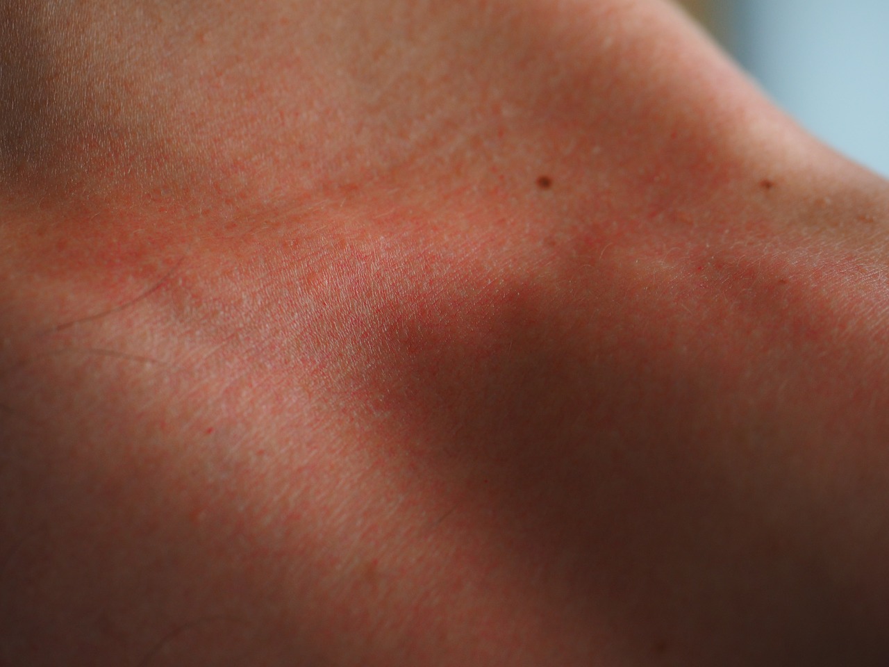 Image - sunburn skin red flushed