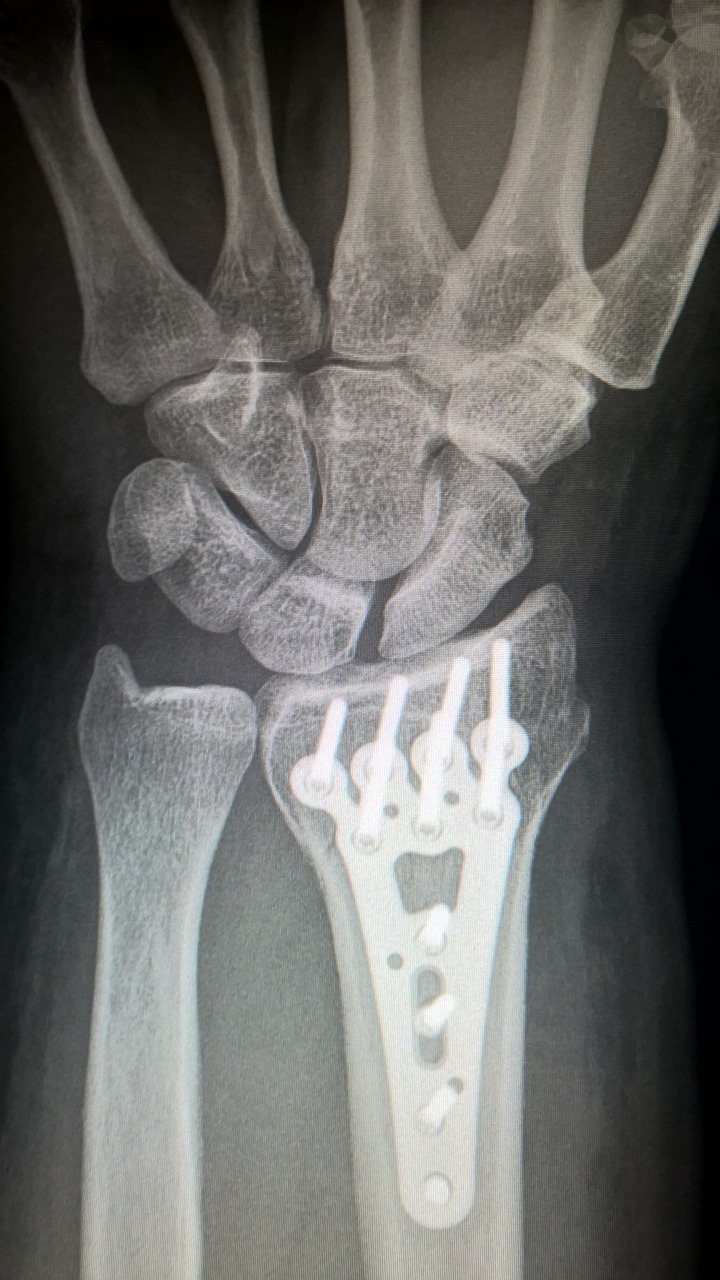 Image - broken arm plate fixation