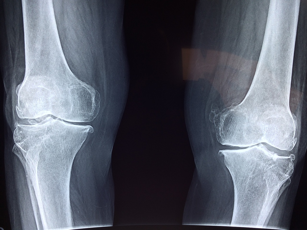 Image - knee x ray medical anatomy