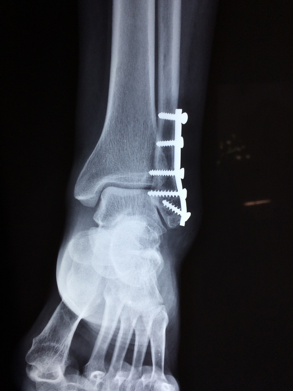 Image - ankle fracture foot medical