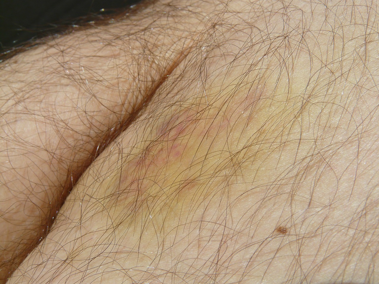 Image - blue blot haematoma hematoma